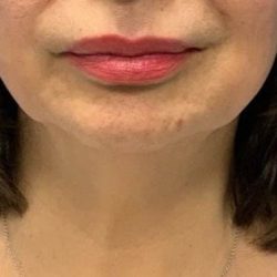 Submental Liposuction Before & After Patient #2088