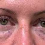 Lower Blepharoplasty Before & After Patient #2090