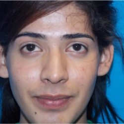 Rhinoplasty Before & After Patient #2135