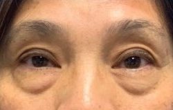 Lower Blepharoplasty Before & After Patient #2091