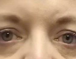 Upper Blepharoplasty Before & After Patient #2092