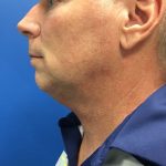 Chin Implant Before & After Patient #2057