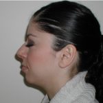 Rhinoplasty Before & After Patient #2136
