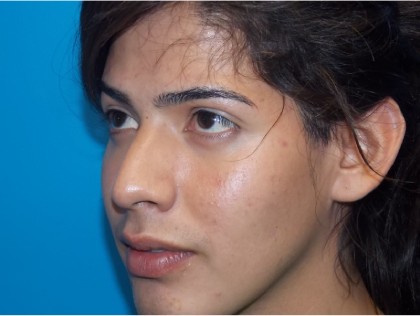 Rhinoplasty Before & After Patient #2135