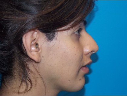 Rhinoplasty Before & After Patient #2135