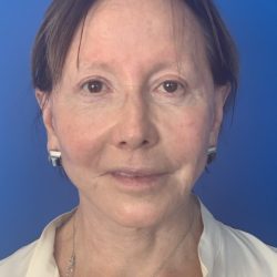 Face & Neck Lift Before & After Patient #2098