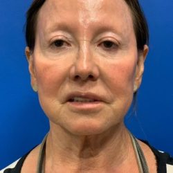 Face & Neck Lift Before & After Patient #2098