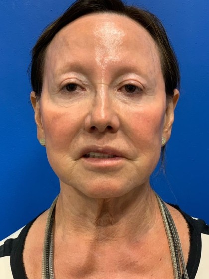Face & Neck Lift Before & After Patient #2098