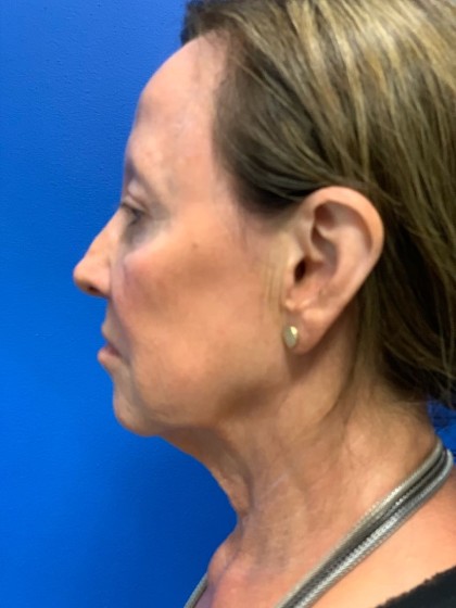 Face & Neck Lift Before & After Patient #2098