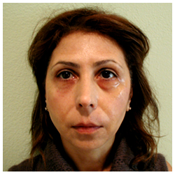 Restylane Before & After Patient #1126