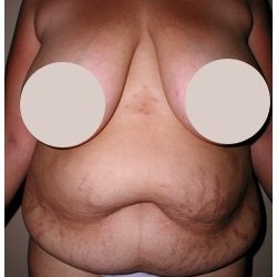 Tummy Tuck Before & After Patient #1051