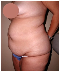 Tummy Tuck Before & After Patient #1049