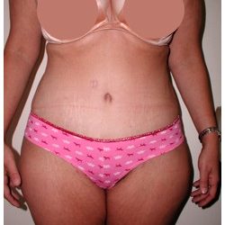 Tummy Tuck Before & After Patient #1049