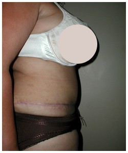 Tummy Tuck Before & After Patient #1051