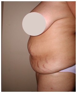 Tummy Tuck Before & After Patient #1051