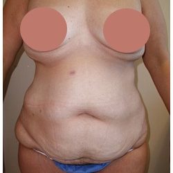 Tummy Tuck Before & After Patient #1049