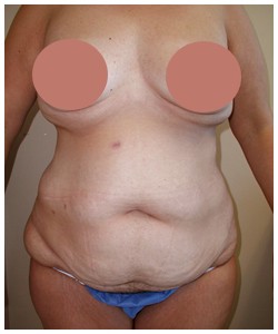 Tummy Tuck Before & After Patient #1049