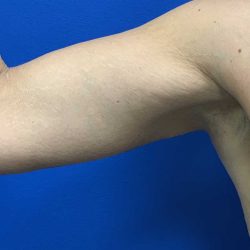 Arm Lift Before & After Patient #1760