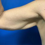 Arm Lift Before & After Patient #1760
