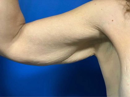 Arm Lift Before & After Patient #1760