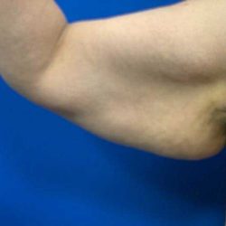 Arm Lift Before & After Patient #1762