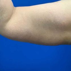 Arm Lift Before & After Patient #1762