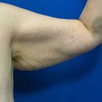 Arm Lift Before & After Patient #1762
