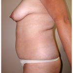 Body Contouring Before & After Patient #1025