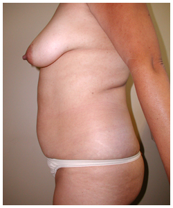Body Contouring Before & After Patient #1025