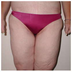 Body Contouring Before & After Patient #1026