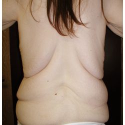 Body Contouring Before & After Patient #1027