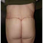 Body Contouring Before & After Patient #1027