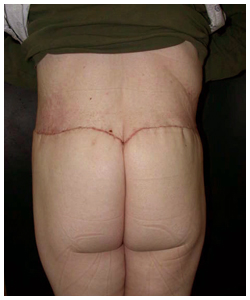 Body Contouring Before & After Patient #1027