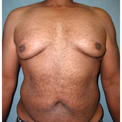 Body Contouring Before & After Patient #1028