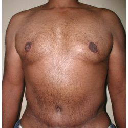 Body Contouring Before & After Patient #1028