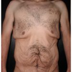 Body Contouring Before & After Patient #1029