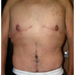 Body Contouring Before & After Patient #1029
