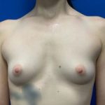Breast Augmentation Before & After Patient #1800