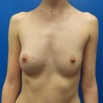 Breast Augmentation Before & After Patient #1821