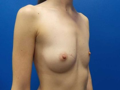 Breast Augmentation Before & After Patient #1821