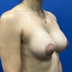 Breast Augmentation Before & After Patient #1820
