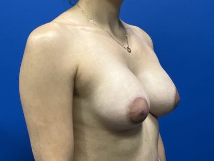 Breast Augmentation Before & After Patient #1820