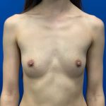 Breast Augmentation Before & After Patient #1801