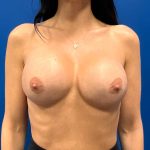 Breast Augmentation Before & After Patient #1802