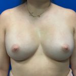 Breast Augmentation Before & After Patient #1803