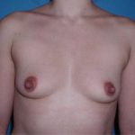 Breast Augmentation Before & After Patient #1807