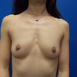 Breast Augmentation Before & After Patient #1809