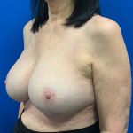 Breast Revision Before & After Patient #1974