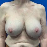 Breast Revision Before & After Patient #1974
