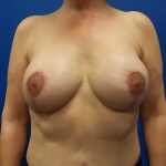 Breast Revision Before & After Patient #1975